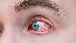 Sudden Eye Redness: When Is It Serious & When Should You See a Doctor?